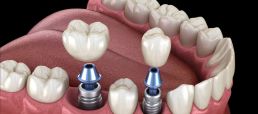 Dental Care Costa Rica